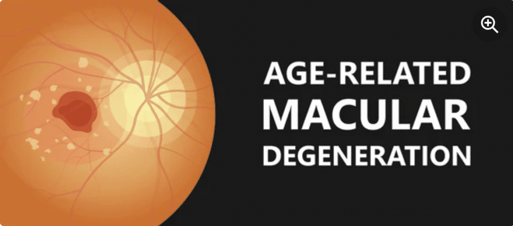 Macular Degeneration Treatment Smart Laser Eye Center