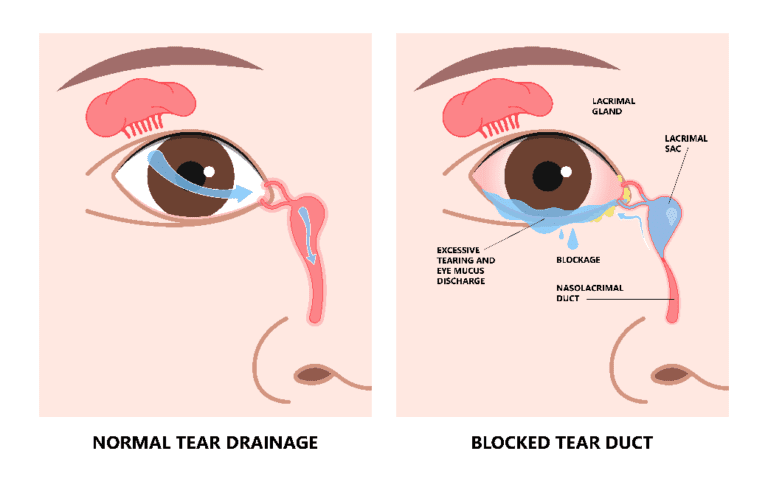 Blocked Tear Duct Surgery - Smart Laser Eye Center