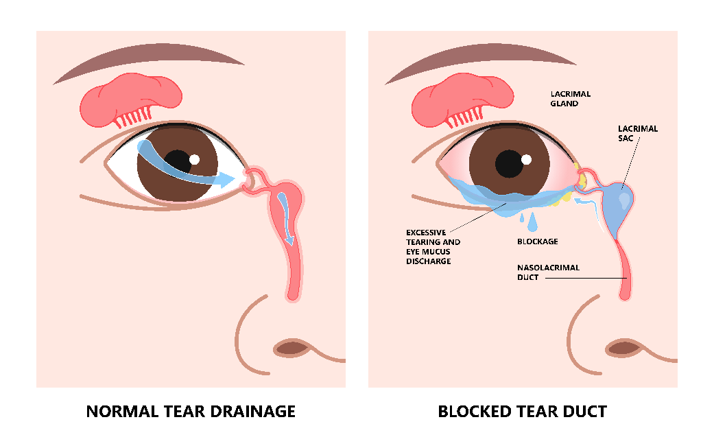 Blocked Tear Duct Surgery Smart Laser Eye Center 