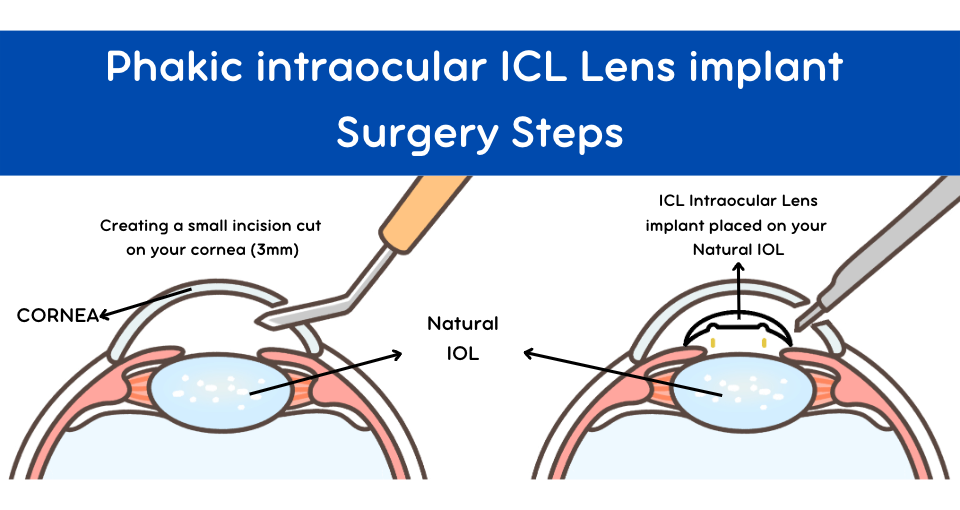 Phakic Lens Surgery - Intraocular ICL Smart Laser Eye Center