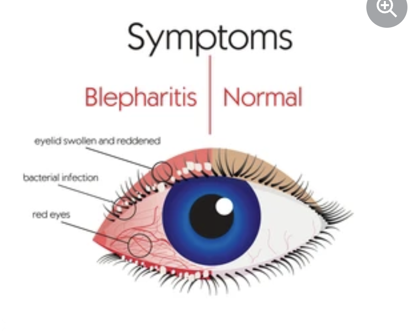 Blepharitis Treatment - Smart Laser Eye Center