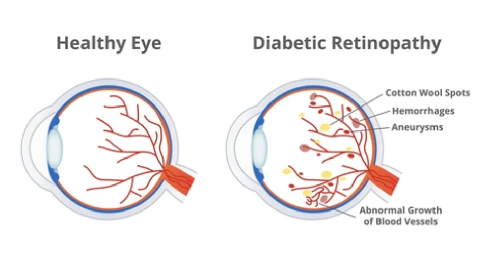 Diabetic Retinopathy Disease - Smart Laser Eye Center